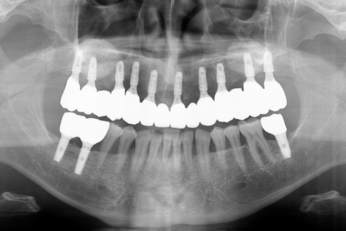 임플란트 치료 후 X-ray