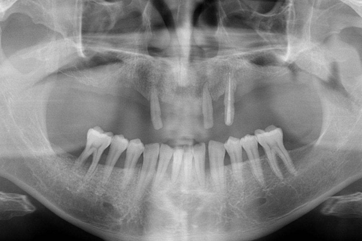 임플란트 치료 전 X-ray