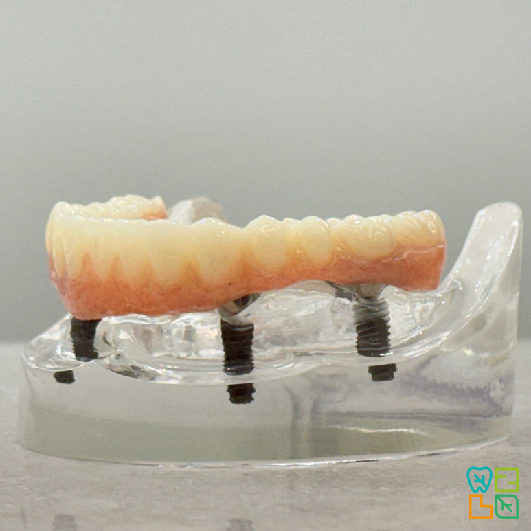 Magic4 전악 임플란트 3D 일러스트